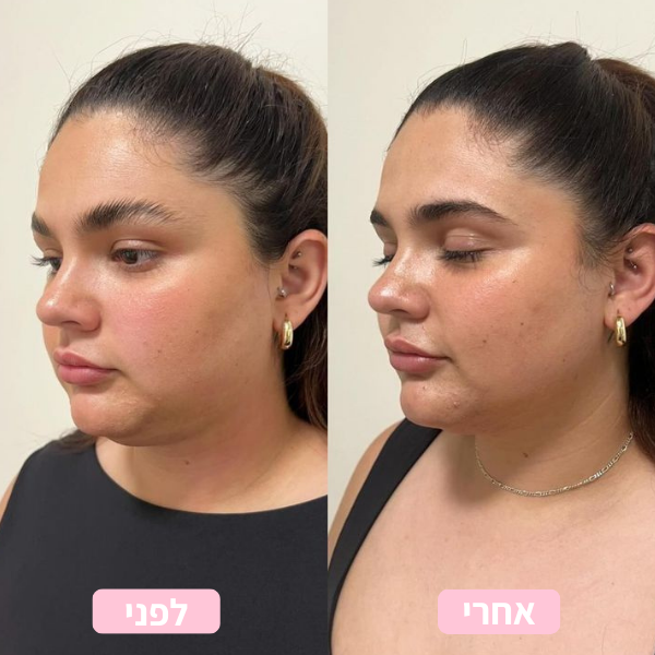 לפני ואחרי 3